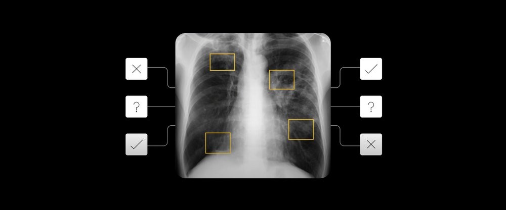 An x-ray showing AI detecting signs of TB